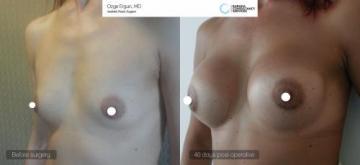 Breast_aug_Oe_17_1