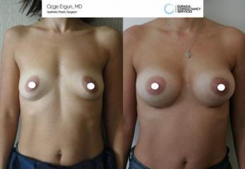 Breast_aug_Oe_3_1