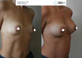 Breast_aug_Oe_3_2