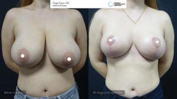 be_af_zln_breast_lift1