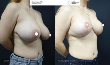 be_af_zln_breast_lift2