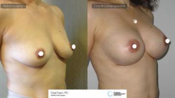 Breast_aug_Oe_18_2