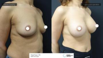 ba_af_zks_breast_aug1