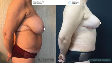 be_af_abl_tummytuck_breastlift_1