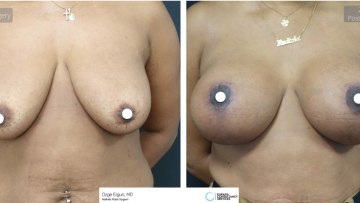 be_af_ardg_breast_surgery_1