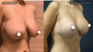 be_af_dsv_breastlift2