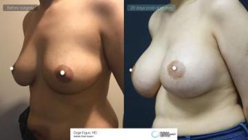 be_af_nfr_Breast_Augmentation