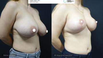 be_af_zln_breast_lift2