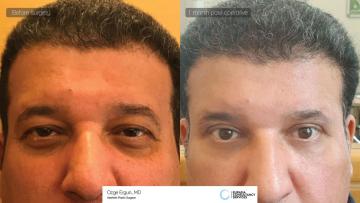 lower_eyelid_be_af_Nasser_Alabhoul