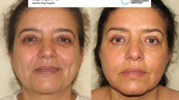 Face_Lift_OE_2_1_