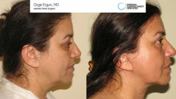 Face_Lift_OE_2_2