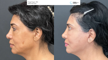 be_af_facelift_1_69345725