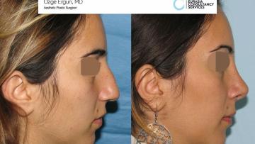 rhinoplasty