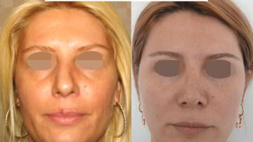 rhinoplasty