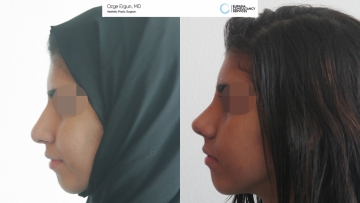 rhinoplasty