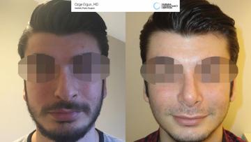 rhinoplasty