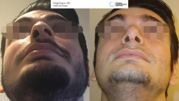 rhinoplasty