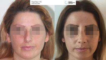 rhinoplasty