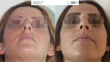 rhinoplasty