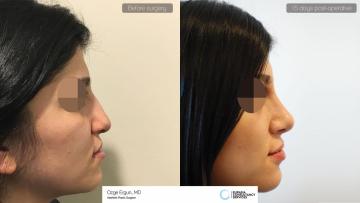 rhinoplasty