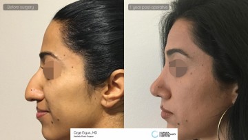 rhinoplasty