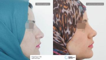 rhinoplasty