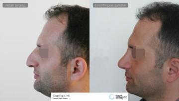 rhinoplasty