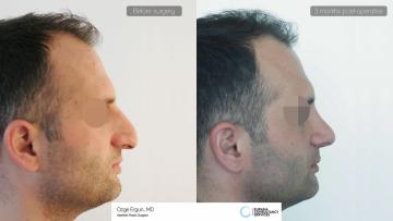 rhinoplasty