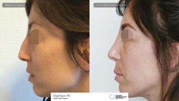 rhinoplasty