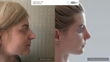 rhinoplasty