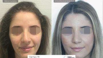 rhinoplasty