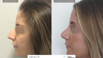 rhinoplasty