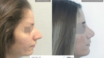 rhinoplasty