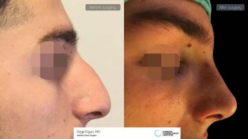 rhinoplasty