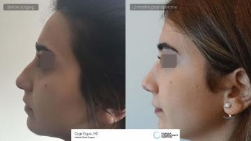 rhinoplasty