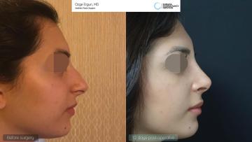 rhinoplasty