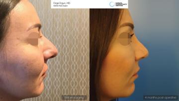 rhinoplasty