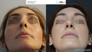 rhinoplasty