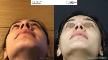 rhinoplasty