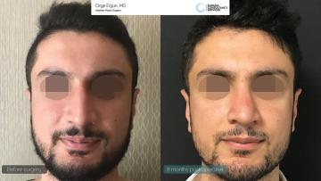 rhinoplasty