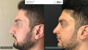 rhinoplasty