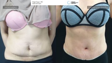 ba_af_sf_tummytuck_vaserlipo1