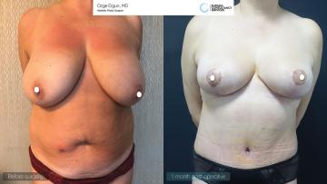 be_af_abl_tummytuck_breastlift_3