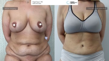 be_af_mam_tummytuck_1