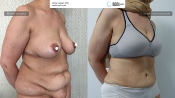 be_af_mam_tummytuck_2