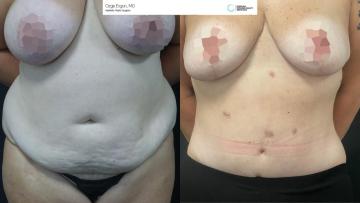 be_af_tummytuck_2_60083144