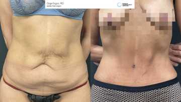 be_af_tummytuck_2_62995706