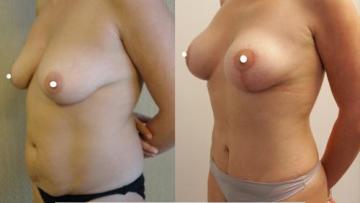 mastopexia__tummytuck_1_3