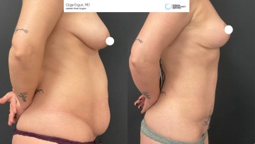 be_af_tummytuck_1__67932006