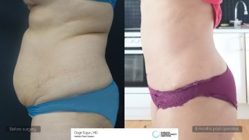 ba_af_mdn_tummy_vaserlipo_2-copy